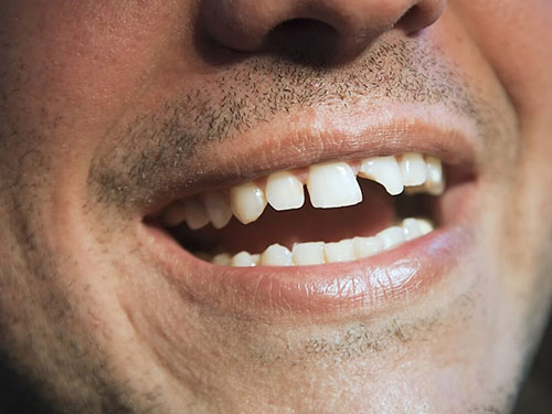 Cracked or Severely Damaged Teeth